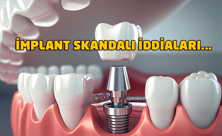 İMPLANT SKANDALI İDDİALARI...